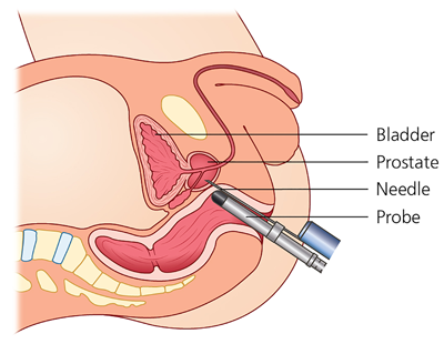 barbara moffatt add cum during prostate exam photo